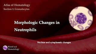 Morphologic Changes in Neutrophils nuclear and cytoplasmic changes [upl. by Sualkcin]