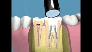 Tutti i passaggi della terapia canalare e della capsula dentale [upl. by Woodley]