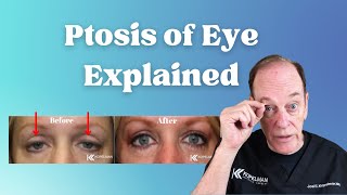 Ptosis of the Eye Explained  Eyelid Surgery for Droopy Eyelids [upl. by Yelsha]