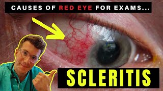 Causes of Red Eye  Part 3 SCLERITIS [upl. by Lessur200]