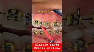 Elastic Bands  BRACES close the Gap [upl. by Jamieson]