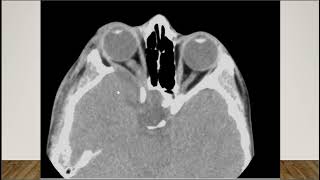 Short Case Discussion  Neurofibromatosis Type 1 [upl. by Niuq]