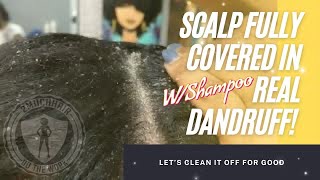 2MuchHair Full Dandruff Treatment w Dry Scratches an Shampoo asmr [upl. by Marra44]