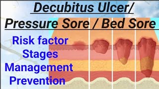 FON  Decubitus Ulcer Pressure Sore Bed Sore Pressure Ulcer NORCET AIIMS RRB nandanio4t [upl. by Nathanial200]