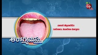 White Tongue Causes And Tips For Prevention  Aarogyamastu  04th December 2018  ఆరోగ్యమస్తు [upl. by Llatsyrc]