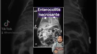 Enterocolitis necrosante ⚠️🧑‍⚕️ pediatrics intestino medico sabiasque medstudent med [upl. by Ellehcear]