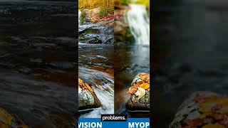 Types of myopia explained  Myopic eye refractiveerror myopia learnoptometry shorts [upl. by Ileana]