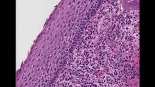 Histopathology Cervix  Squamous cell carcinoma [upl. by Doownelg]