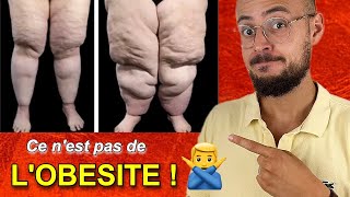 Le LIPOEDEME ou maladie des GROSSES JAMBES [upl. by Garrek]