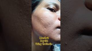 Day32 Using Tretinoin 0025 cream viralvideo tretinoin skincare shorts youtubeshorts [upl. by Lemhaj585]