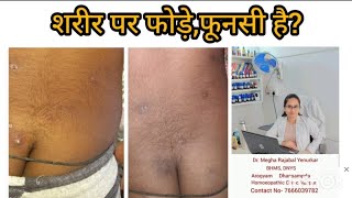 Skin pustules  Homoeopathic Treatment 🤩 [upl. by Kora523]