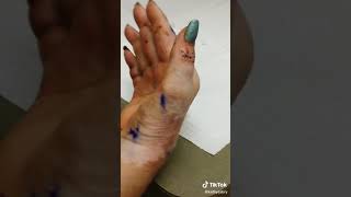 Post hand reconstructive surgery removing stitches part 2 [upl. by Alage]