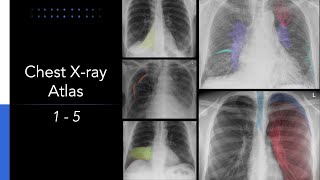 Chest Xray Atlas 5 Essential Chest Xrays for Students [upl. by Nnayelhsa]