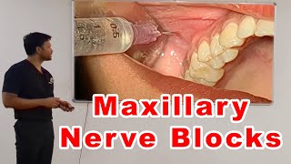 Maxillary Nerve Blocks Lecture  Dr Zibran Khan [upl. by Sauncho]