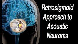 Retrosigmoid or Suboccipital Approach to Acoustic Neuroma Surgical Removal [upl. by Atoiyanap]