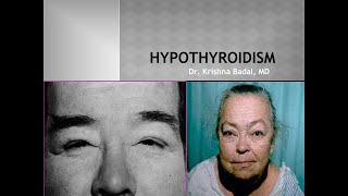 Hypothyroidism Myxedema [upl. by Auqemahs]