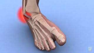 Mayo Clinic Minute Ankle sprains 101 [upl. by Nemzaj566]