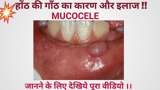 Mucocele  cause and treatment होंठ की गाँठ का इलाज ओर कारण [upl. by Eitsud]