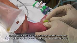 Paediatric Anaesthetics Chapter 7  Long saphenous IV neonate 1 [upl. by Atteiluj]