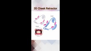 3D Cheek Retractor and Mouth Opener [upl. by Tu]