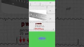 Atrial flutter ecg mbbs nursing [upl. by Dore]