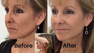 How to Get Rid of Jowls with Dermal Fillers Step 2 [upl. by Eenaej]