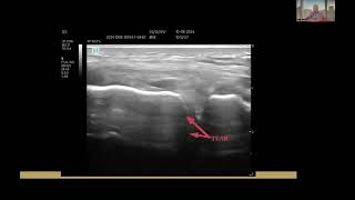 How to tell if you have a meniscus tear without MRI Using Ultrasound To Diagnose A Meniscal Tear [upl. by Foulk]