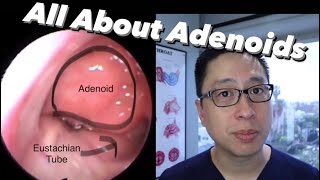 Adenoids and Adenoidectomy what are they when do we remove them what is the surgery like [upl. by Aihselat]