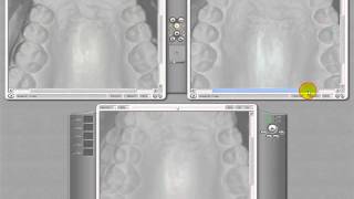 FantaMorph tutorial for morphing for dental purposes [upl. by Sehguh]