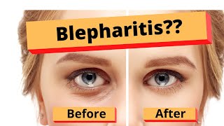 Blepharitis How to treat Blepharitis Best Home Treatment [upl. by Dani]