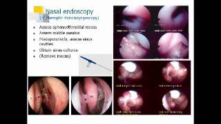 Sinusitis and Nasal Polyps Dan Hamilos MD [upl. by Hubert955]