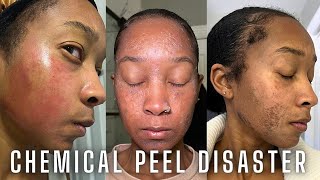 Chemical Peel Nightmare Full Peeling Process Before During and After NEVER AGAIN [upl. by Nahaj]