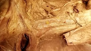 Aorta  Vena Cava  Azygos Vein  Cisterna Chyli Dissection and Clinical Narration – Sanjoy Sanyal [upl. by Justine]