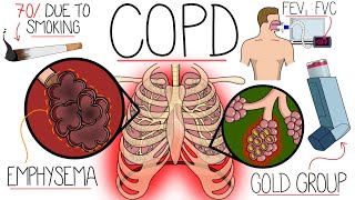 Understanding Chronic Obstructive Pulmonary Disease COPD Explained Clearly [upl. by Doxia]