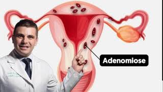 Adenomiose no Útero  Sintomas e Tratamento [upl. by Eugine543]