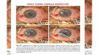 Endothelial keratoplasty DMEK DSEK DLEK PDEK Ophthalmology [upl. by Squires]