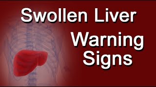 Swollen Liver Warning Signs [upl. by Tshombe]