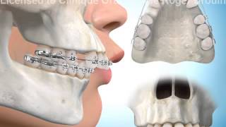 Extractions de dents pour correction surplomb horizontal [upl. by Iduj612]