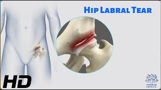 Hip Labral Tear The Hidden Culprit of Hip Pain [upl. by Gilford]