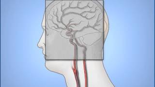 Diagnostic Cerebral Angiography [upl. by Wadleigh]