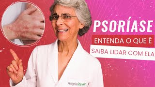 Psoríase entenda o que é e saiba lidar com ela [upl. by Albric170]