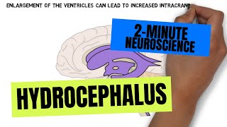 2Minute Neuroscience Hydrocephalus [upl. by Sukramed]