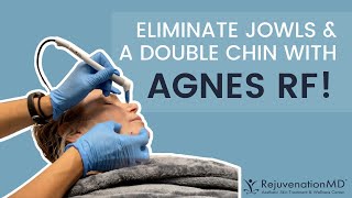 Agnes RF Treatment for Jowls and Double Chin [upl. by Ennahs598]