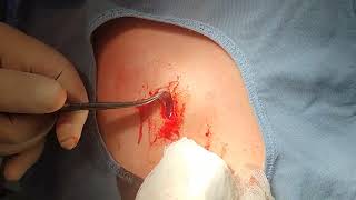 Dorsal Cyst Excision [upl. by Tisbee]