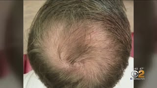 Can PRP Injections Spark Hair Growth [upl. by Antoine]