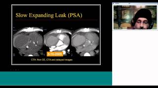 PostOperative Aorta and Stent Graft Imaging by Prof Satinder Singh [upl. by Ramses779]