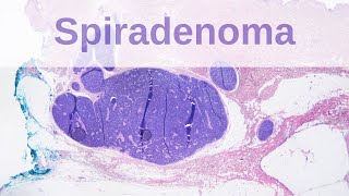 Eccrine Spiradenoma  Pathology mini tutorial [upl. by Cloe519]