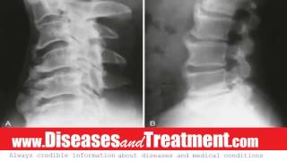 DISH Diffuse Idiopathic Skeletal Hyperostosis  Causes Diagnosis Symptoms Treatment Prognosis [upl. by Siouxie]