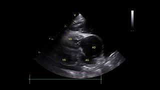 ASD and pulmonary hypertension which resulted in righttoleft shunting Eisenmengers syndrome [upl. by Conrado701]