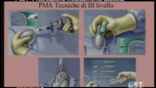 PMA  Procreazione medicalmente assistita [upl. by Nylirehc]